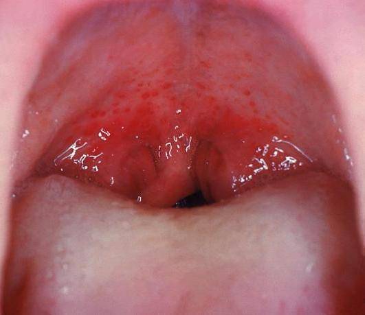 what are the symptoms of  strep throat
