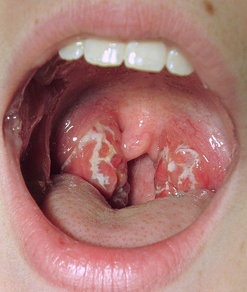 what are the symptoms of  strep throat