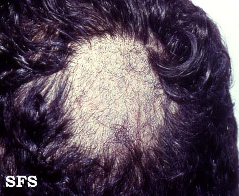 Help for Hair Loss: Drug-Induced Hair Loss - WebMD