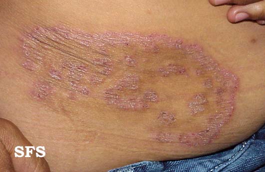 Rash On Baby S Trunk - Doctor answers on HealthTap