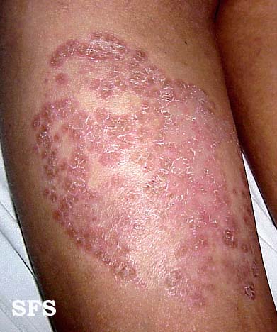 tinea_corporis5