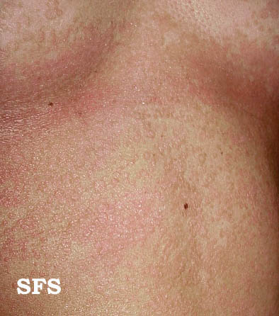 Tinea Versicolor in Adults: Condition, Treatments, and ...