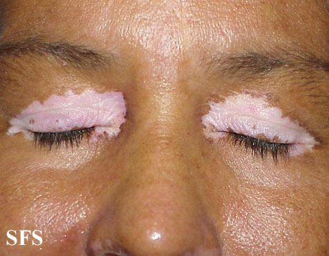 Vitiligo (White Patchy Skin Disease) Causes, Symptoms, Pictures 