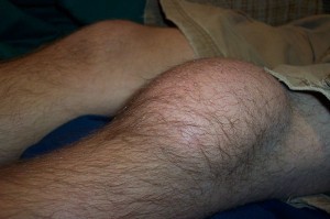 Swollen Knee