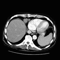 Intestinal lymphoma on CT