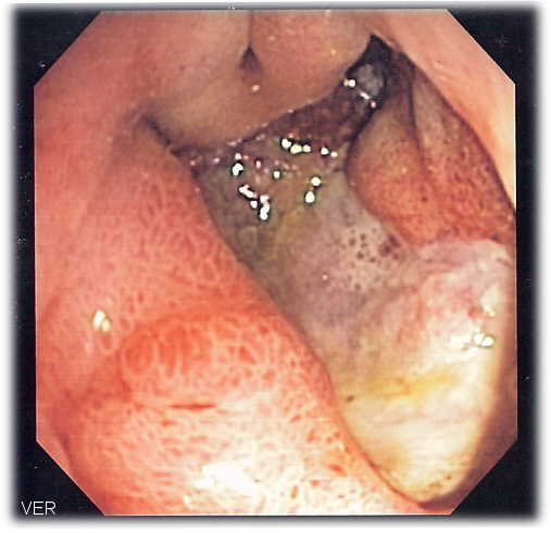 Upper endoscopy (gastroscopy) - gastric ulcer