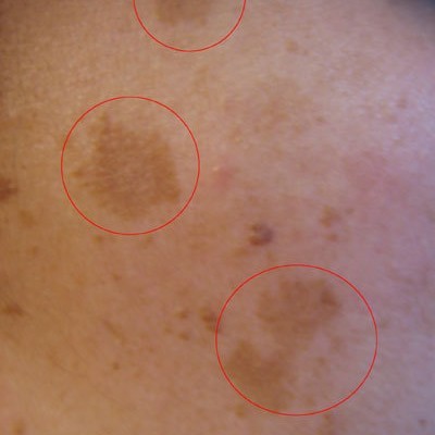 Skin Discoloration, Causes, Pictures of Abnormal Skin Colors - Healthhype
