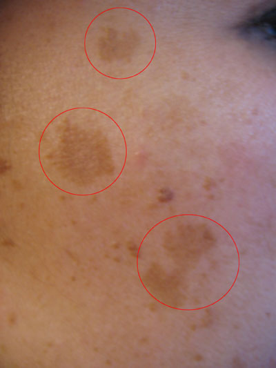 Melasma, Chloasma Pictures (Dark Skin Pigmentation on Face 