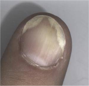 Psoriasis fingernail