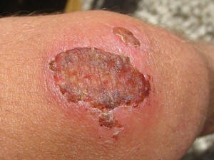 Scab (Skin Wound) – Formation Process, Causes, Pictures ...
