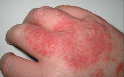 acute eczema