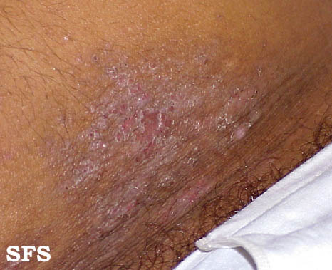 Inguinalis dermatitis: a kúra és a kezelés jellemzői férfiakban és nőkben