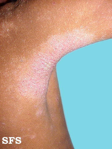 atopic dermatitis armpit