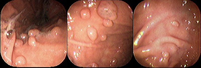 Benign Stomach Tumors (Non-Cancerous Growths) | Healthhype.com