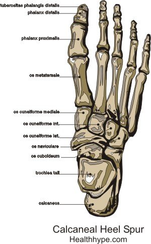 Plantar Calcaneal Spur – Foot Heel Bone 