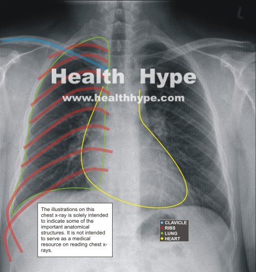 Parts of a Chest X-Ray