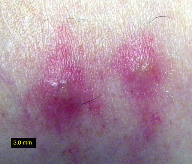 How To Cure A Skin Infection Naturally How To Cure A Skin Infection Naturally