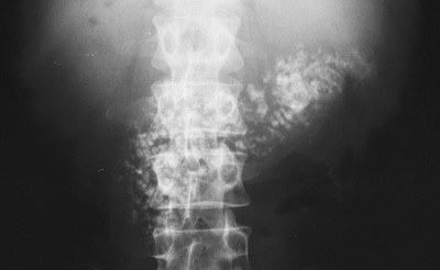 Chronic pancreatitis with calcifications (X-ray image)