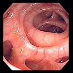Diverticulosis as seen in colonoscopy