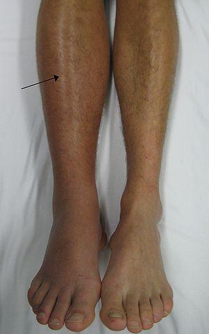 Swollen Calf Muscles – Causes of Swelling of Back of Lower ...