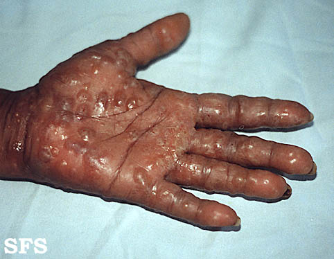 Dyshidrotic eczema - pomphylox