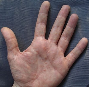 Dyshidrotic Eczema Hand