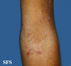elbow eczema