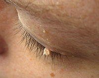 Eyelid wart - papilloma