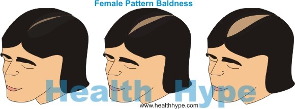 Male Pattern Baldness - Genetic Factors - 23andMe