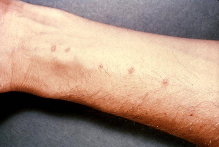 Swimmer's itch - schistosome dermatitis, caused by flukes