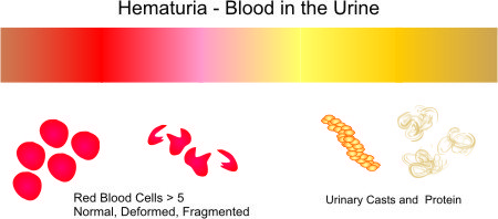 hematuria blood urine