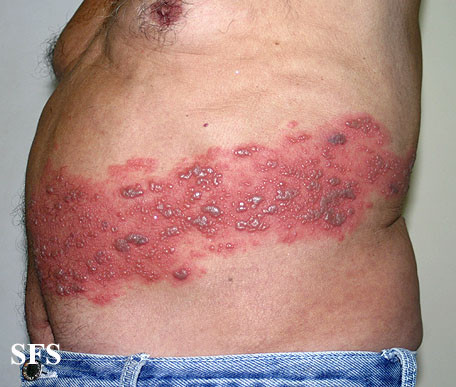 valacyclovir treatment of herpes zoster