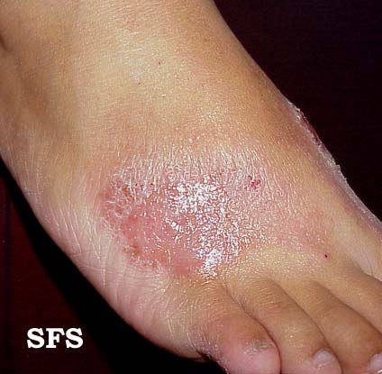Irritant contact dermatitis on the foot