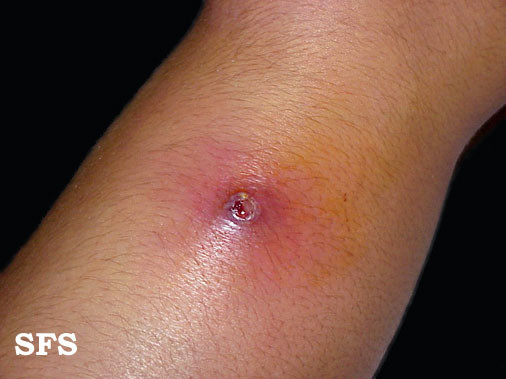 Impetigo Skin Infection Causes Pictures Treatment