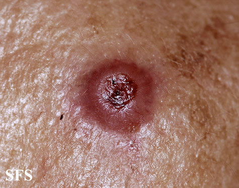 Cancers in HIV / AIDS, Types, Reasons and Skin Pictures | Healthhype.com