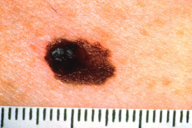 Skin cancer: melanoma