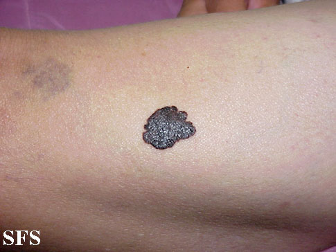 Skin cancer: melanoma on the back