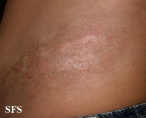 Morphea (Hardened Skin Disease) | Healthhype.com