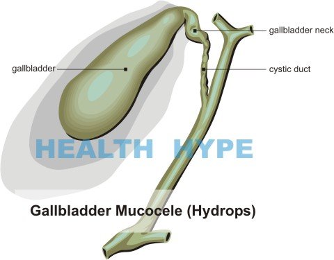 ounces 5 fluid Healthhype.com (Hydrops) Gallbladder   Mucocele