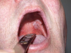 oral leukoplakia in the mouth