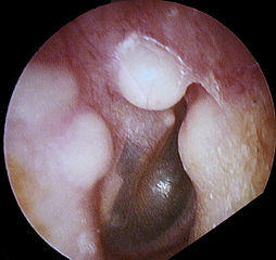 osteoma ear