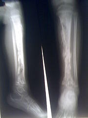 Staph osteomyelitis in the shin bone (tibia)