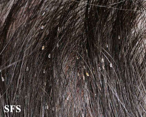 Head lice - Pediculosis capitis