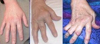 rheumatoid arthritis of the hand