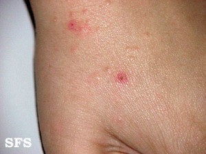 scabies hand