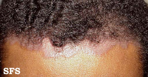 Psoriasis Scalp African American