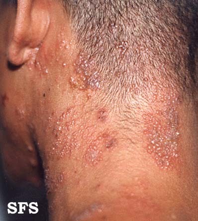 Scalp Infections Causes, Types, Pictures | Healthhype.com