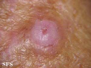squamous_cell_carcinoma_skin_cancer