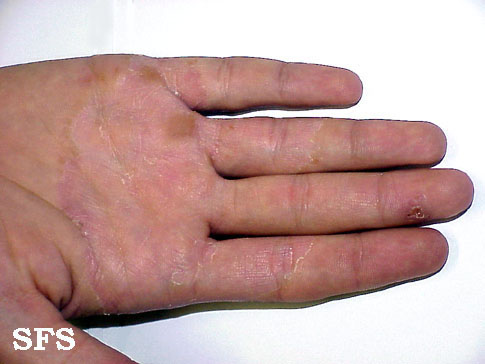 Tinea Manuum (Hand Fungus) Causes, Symptoms, Pictures 