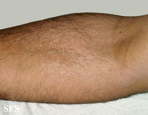 Tinea Versicolor (Neck, Chest, Back, Arm Skin Fungus 